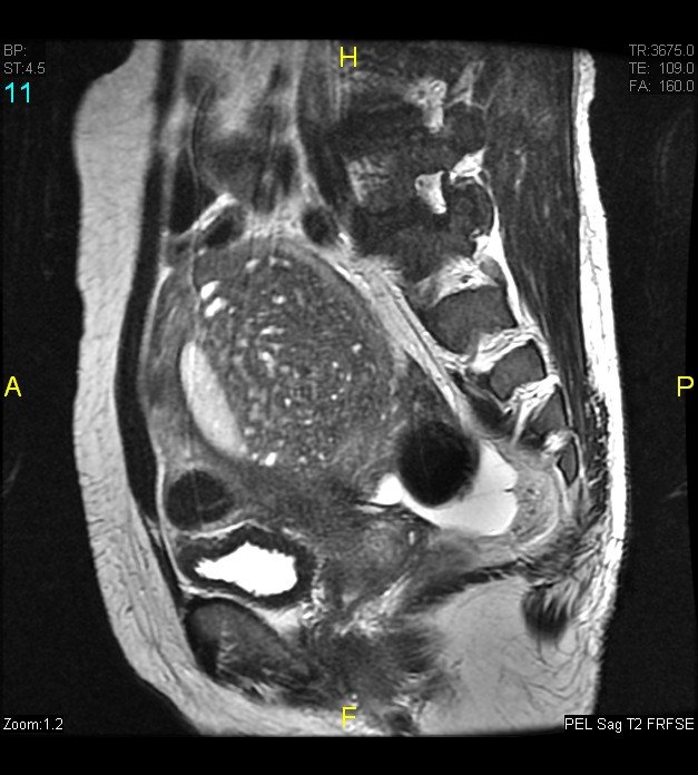 Sagittal T2-weighted MRI of the pelvis showing a bulky uterus with a widened junctional zone and small bright cysts scattered through the muscular wall