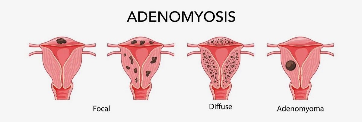 Diagram of the patterns of adenomyosis: focal, shown as tissue concentrated in one or a few spots in the uterine wall; diffuse, shown as tissue scattered throughout the wall; and adenomyoma, a single distinct mass within the wall.