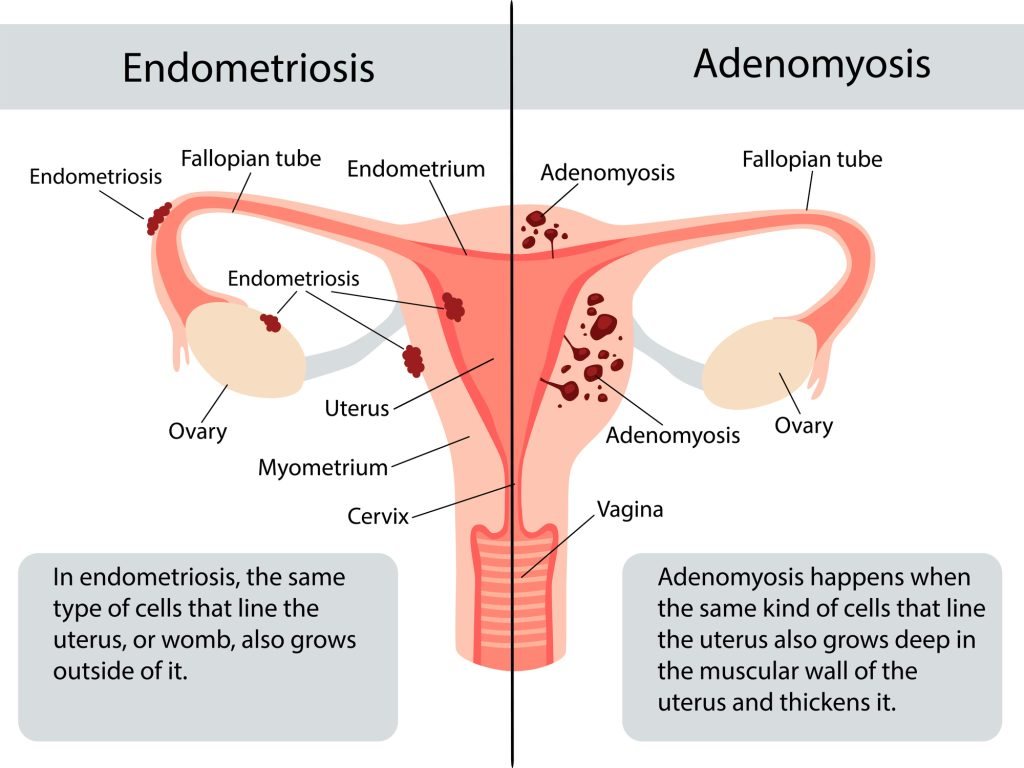 Side-by-side diagram of endometriosis and adenomyosis. On the left, endometriosis: lining-like tissue on the fallopian tube, ovary and outer uterus. On the right, adenomyosis: the same kind of tissue embedded within the muscular wall of the uterus.