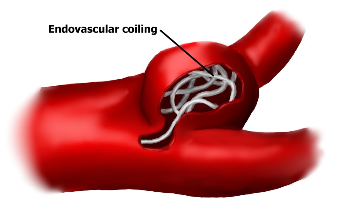 Medical illustration of fine metal coils packed inside a red blood vessel, labeled endovascular coiling
