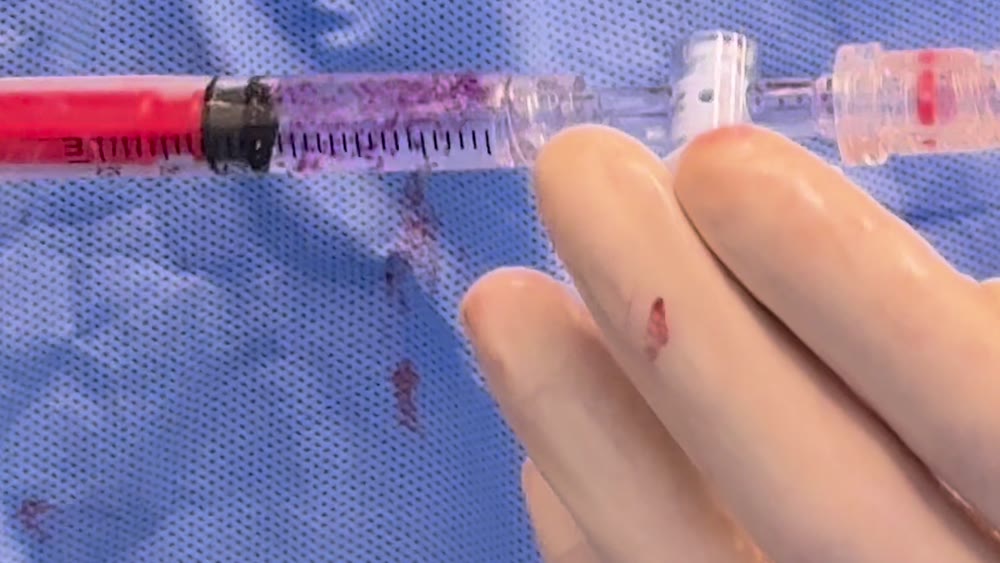 Close-up of a syringe barrel holding hundreds of small purple microspheres suspended in clear contrast, next to the catheter hub