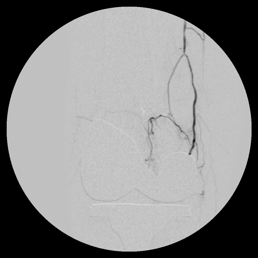 The same artery after embolization: the blush no longer fills