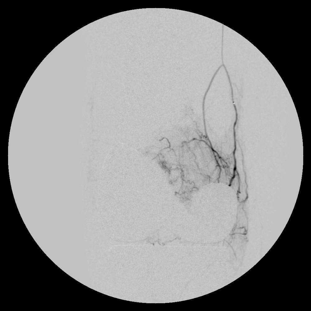 Angiogram before embolization: a dense blush floods in around the implant from the inner thigh