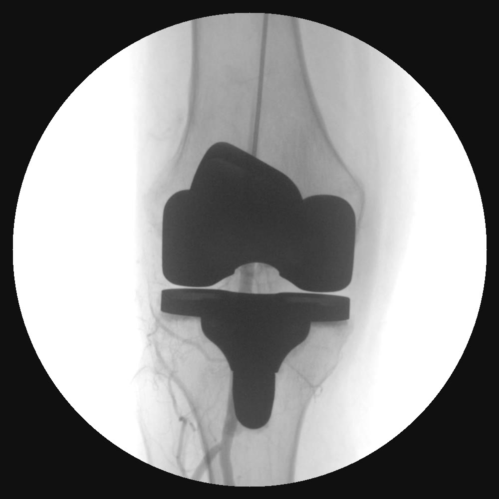 Angiogram of a total knee replacement: the implant is intact, with thread-like abnormal blood vessels visible around it