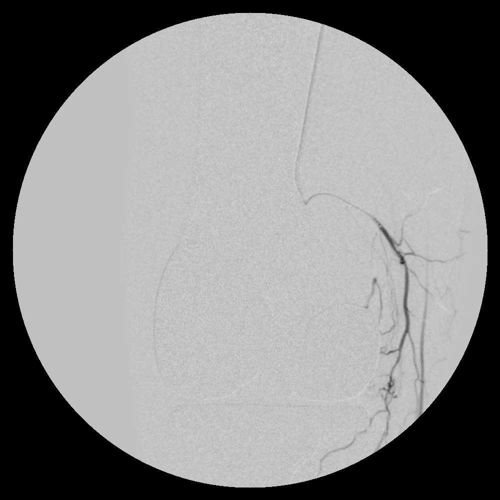 The same artery minutes after embolization: the abnormal tangle no longer fills, while the artery itself keeps flowing
