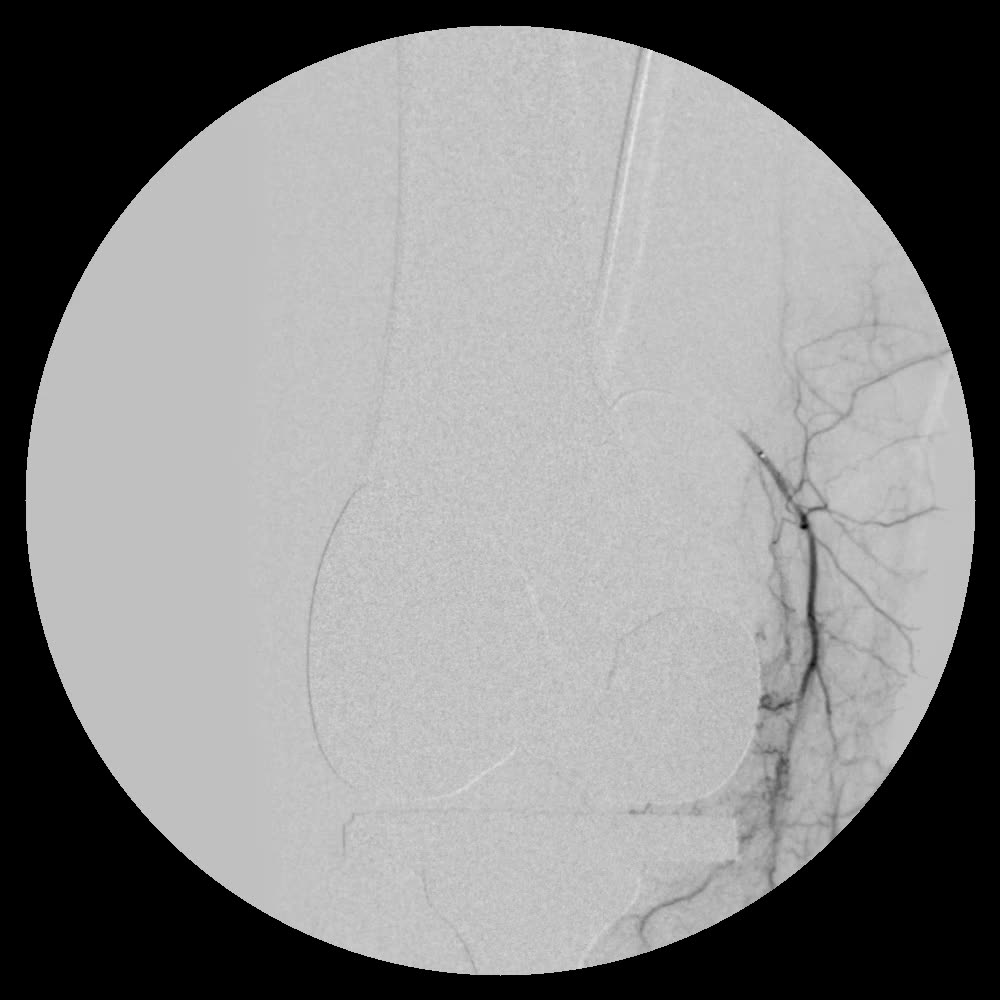 Angiogram before embolization: a dense tangle of abnormal vessels fills along the inner edge of the knee implant