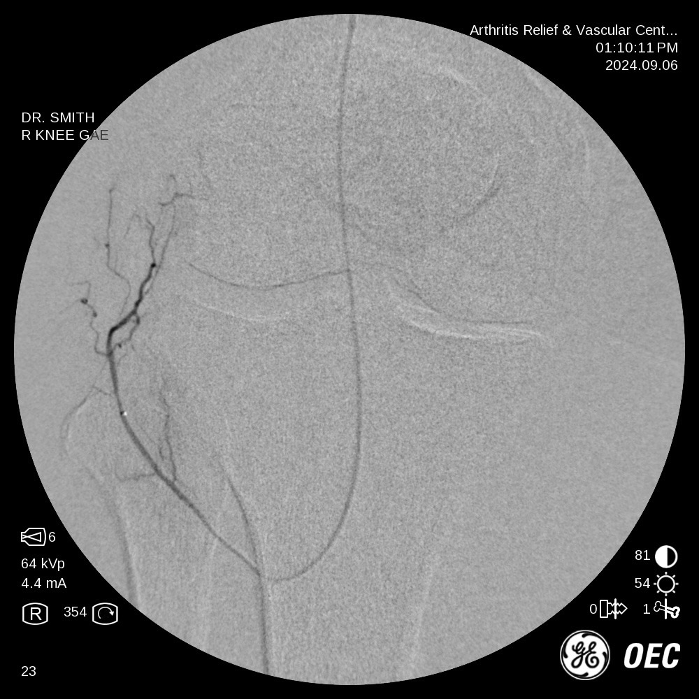 Angiogram after embolization in the same knee: the abnormal vessel cloud no longer fills