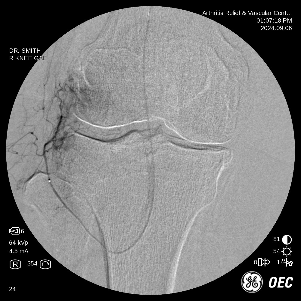 Angiogram before embolization in a second knee: abnormal vessels light up along the joint line