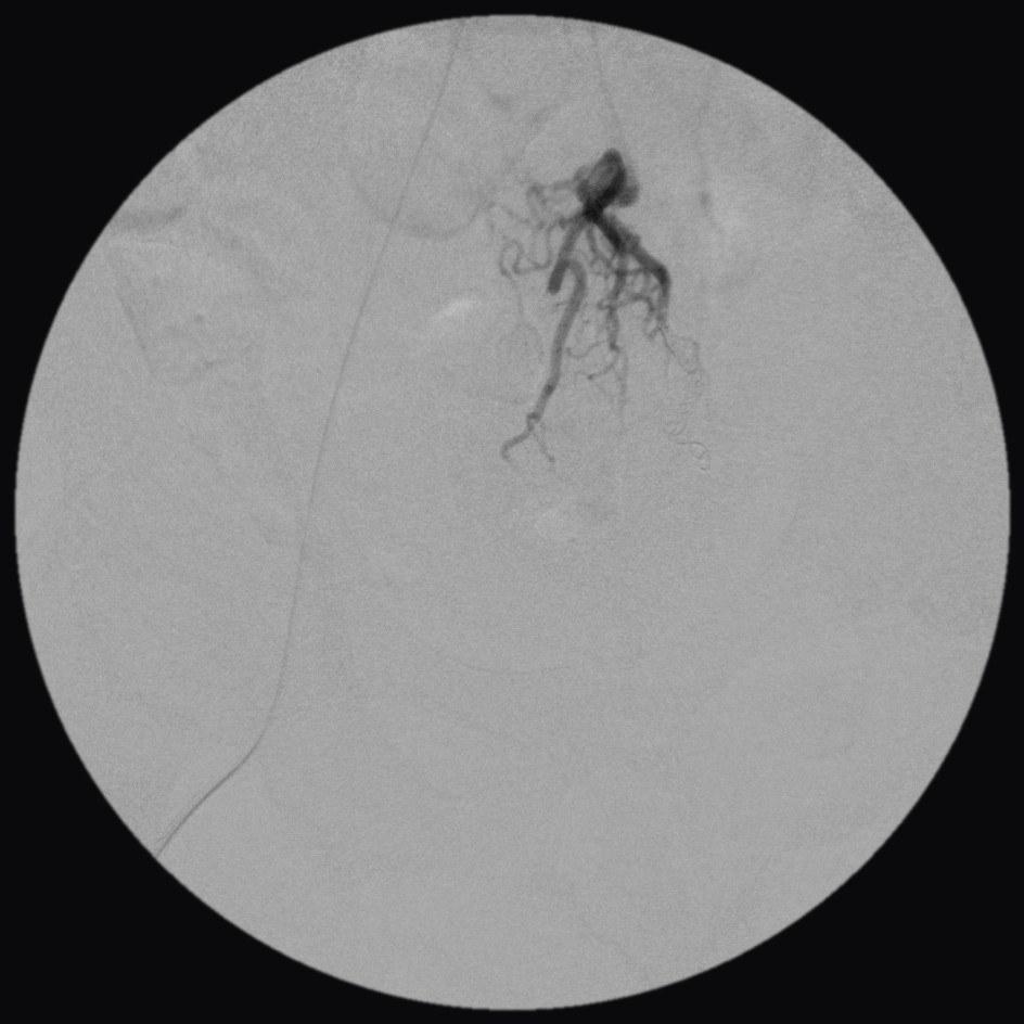 Angiogram after embolization of the left branch: the tangle no longer fills; small coils are visible in the treated branches and the artery above still carries dye