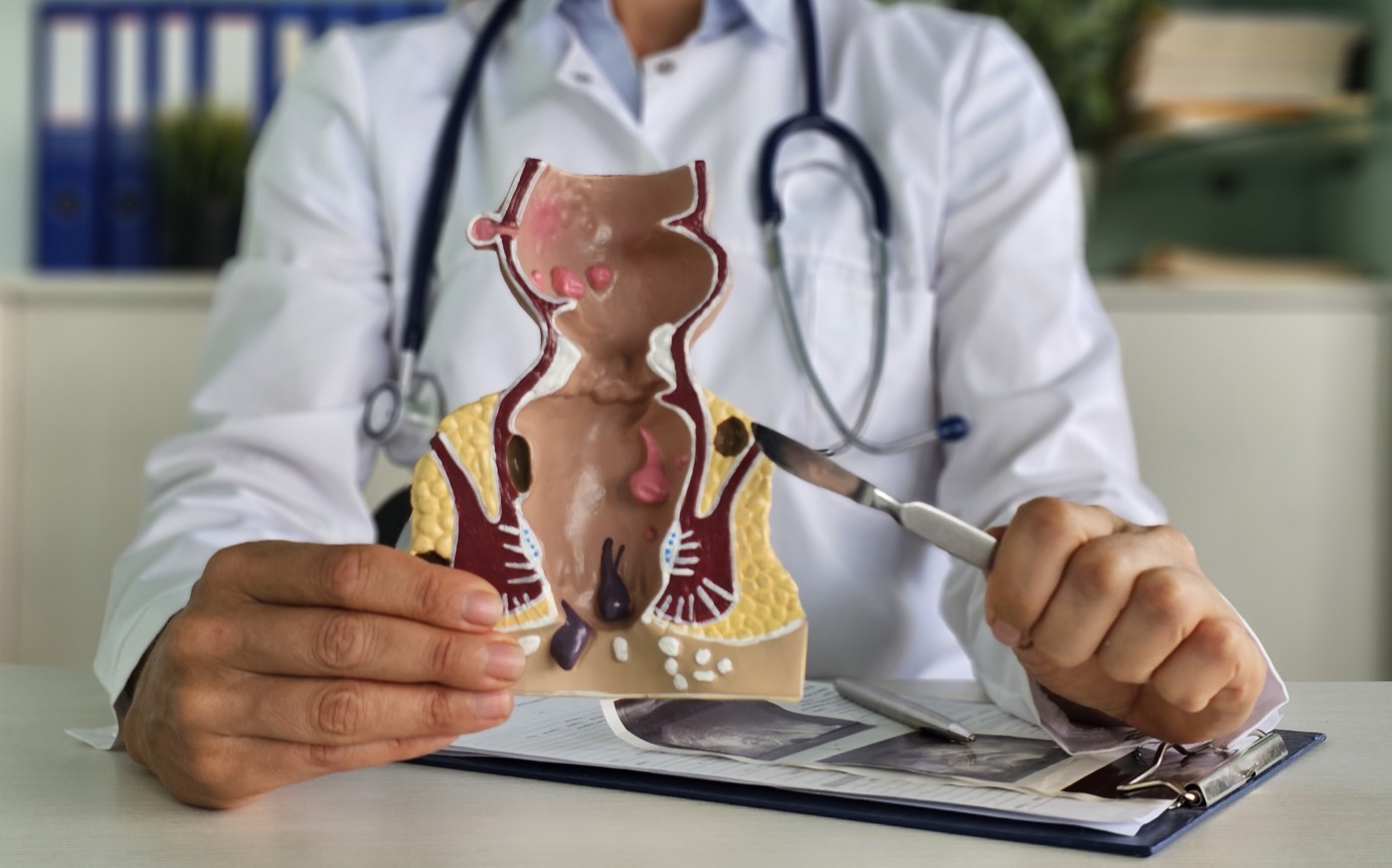 A physician holding a cross-section model of the anal canal that shows internal hemorrhoids above and external hemorrhoids below