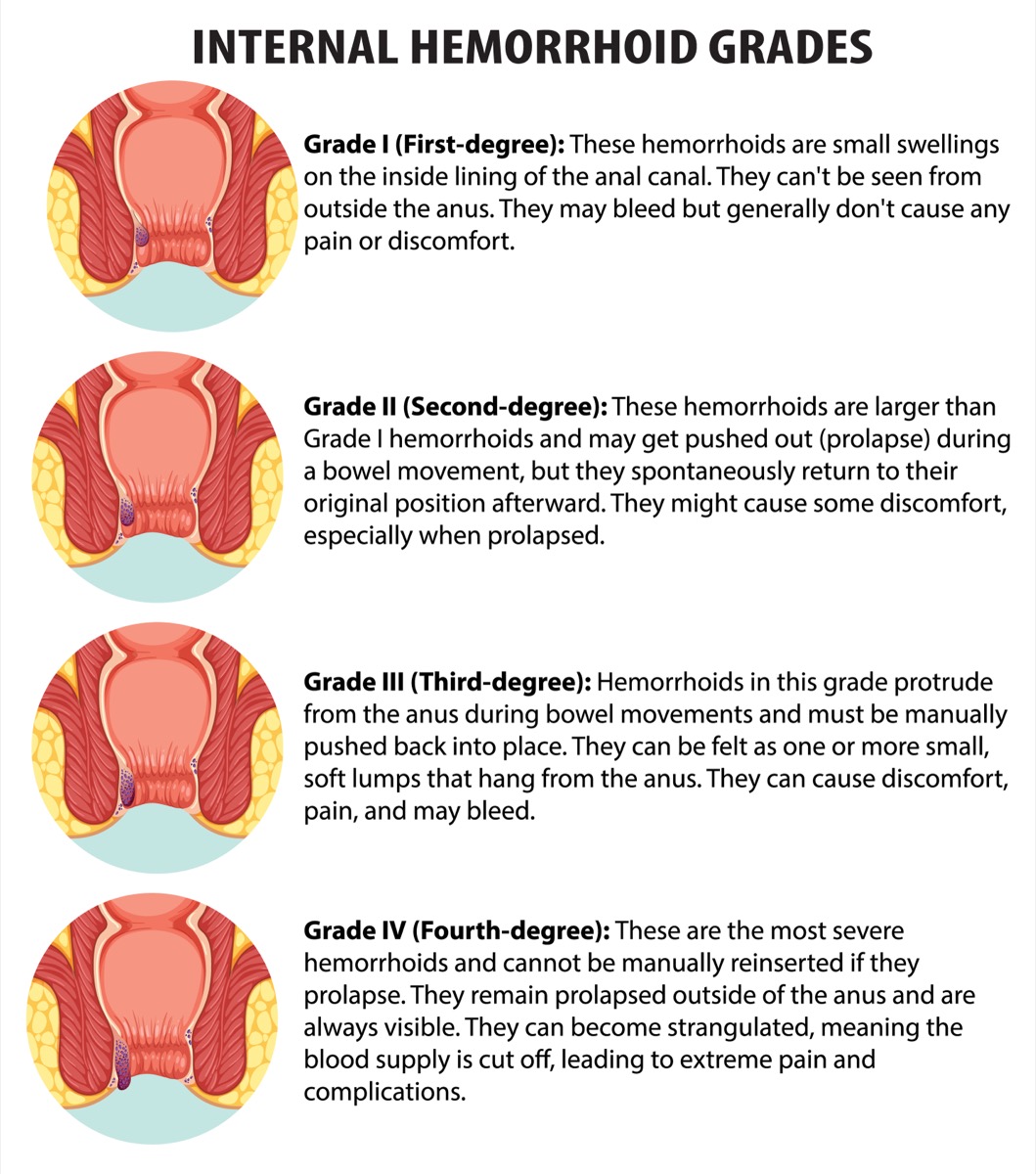 Diagram of the four grades of internal hemorrhoids: grade I stays inside the anal canal, grade II prolapses during a bowel movement and returns on its own, grade III prolapses and must be pushed back in, and grade IV remains prolapsed outside