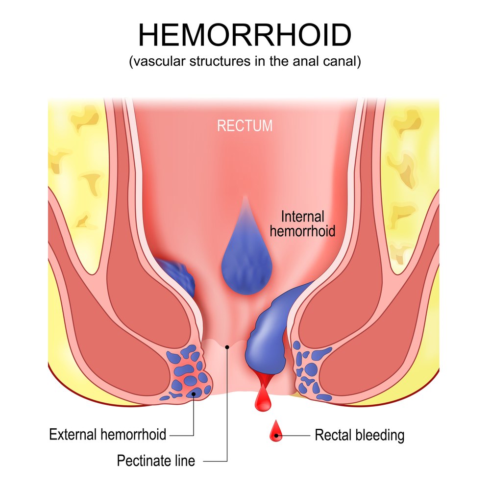 Cross-section diagram of the anal canal showing an internal hemorrhoid above the pectinate line, an external hemorrhoid below it, and bright-red rectal bleeding from the internal hemorrhoid