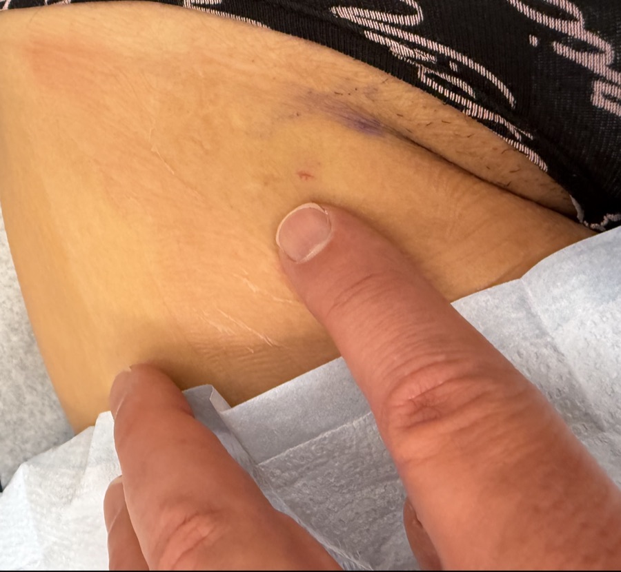 A fingertip pointing to the tiny pinhole access site at the top of a patient&rsquo;s thigh after hemorrhoid artery embolization