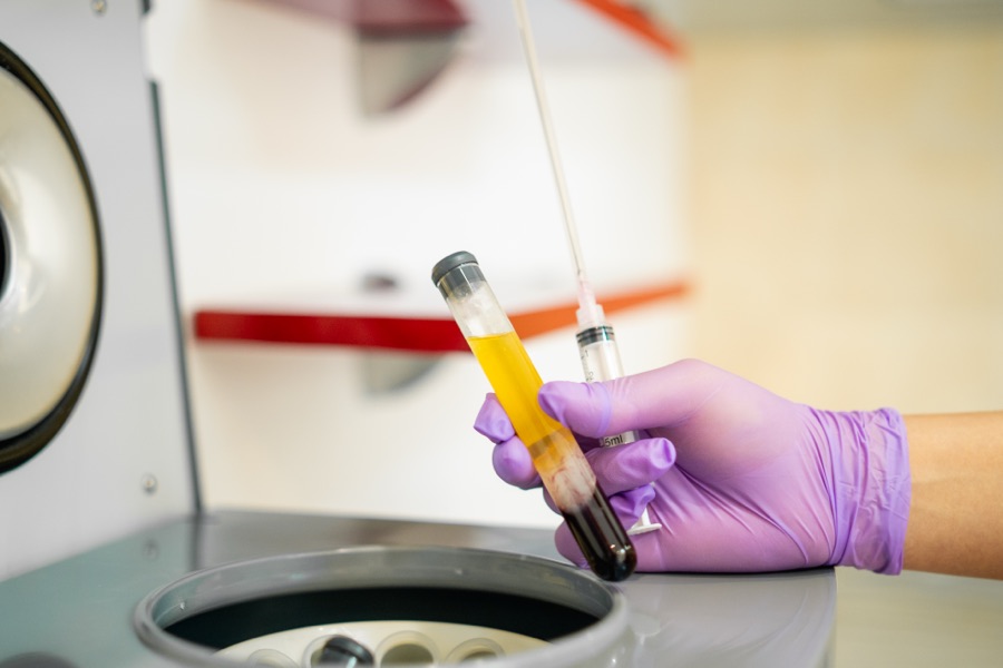A gloved hand holds a tube of centrifuged blood: the golden platelet-rich layer separated and drawn into a syringe