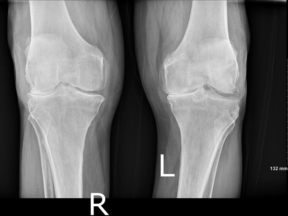 A knee X-ray showing bone-on-bone arthritis