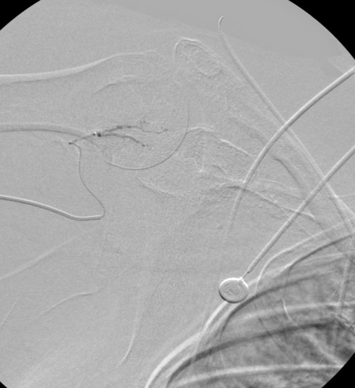 Angiogram after embolization in a second patient: the abnormal vessels no longer fill