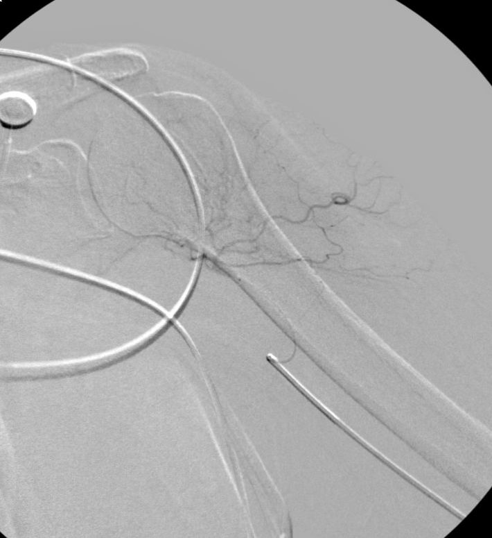 Angiogram after embolization: the abnormal vessel cloud is gone