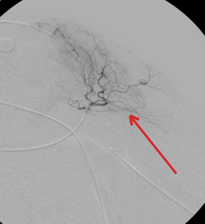 Angiogram before embolization: a dense cloud of abnormal blood vessels in the shoulder