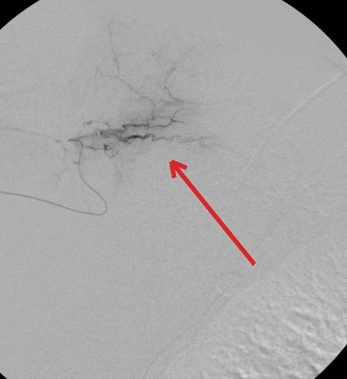 Angiogram before embolization in a second patient: abnormal vessels light up around the shoulder