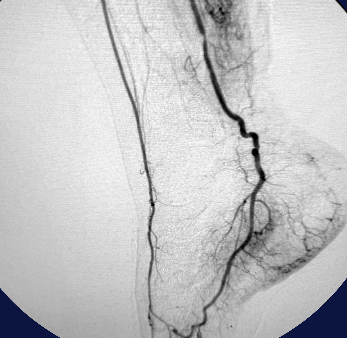 Angiogram from a plantar fascia embolization performed at ARV Centers: the artery running down the inside of the ankle to the heel, with a dense blush of abnormal small blood vessels around the heel attachment