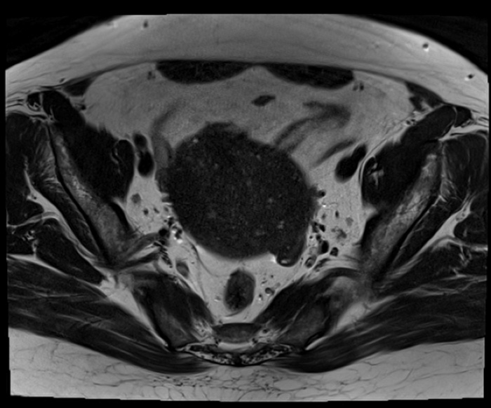 Axial T2-weighted MRI of the pelvis showing an enlarged uterus with adenomyosis