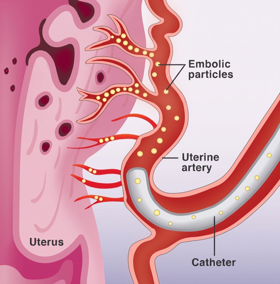 Close-up illustration of uterine artery embolization: embolic particles released from the catheter plug the small vessels of the uterine artery, stopping blood flow to the adenomyosis tissue in the uterus