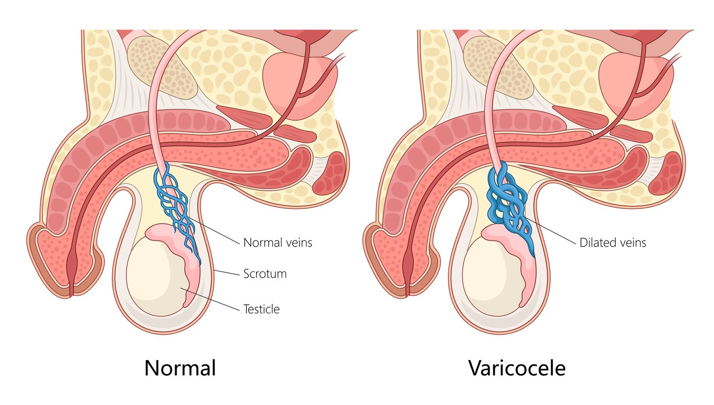 Cut-away medical illustration comparing a normal scrotum and a varicocele: on the left, thin normal veins running along the spermatic cord above the testicle; on the right, the same veins swollen and twisted into dilated cords