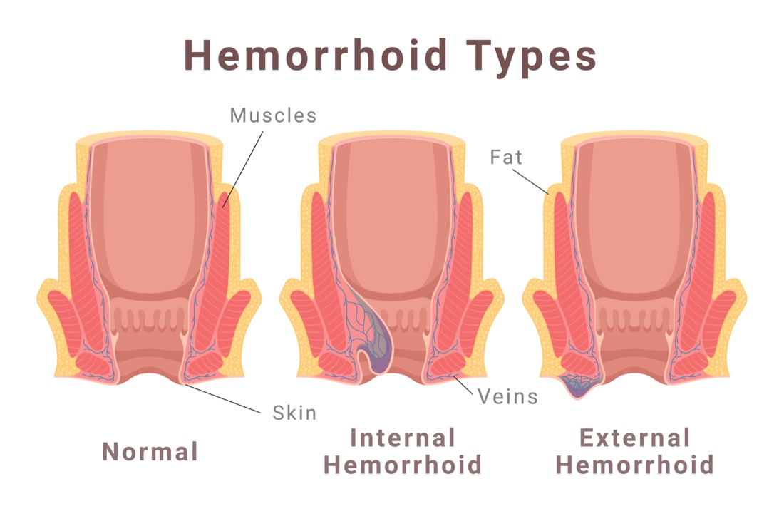 Diagram comparing a normal anal canal, an internal hemorrhoid above the pectinate line, and an external hemorrhoid below it