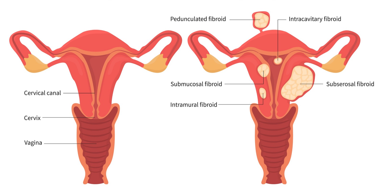 Diagram comparing a normal uterus with a uterus containing fibroids, labeled by type: pedunculated, intracavitary, submucosal, intramural and subserosal