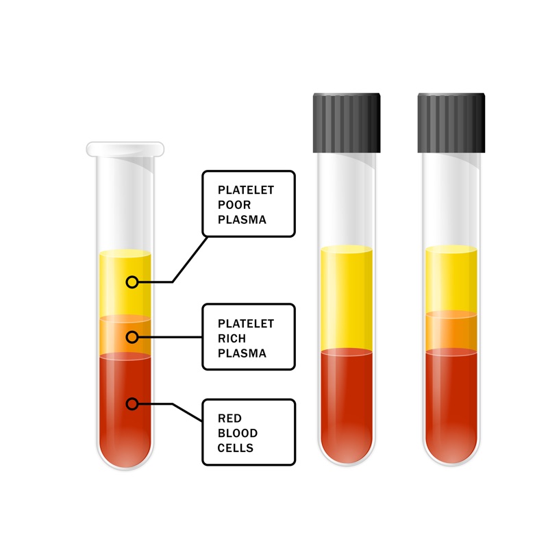 Diagram of a centrifuged blood tube separated into three layers: platelet-poor plasma on top, platelet-rich plasma in the middle, and red blood cells at the bottom