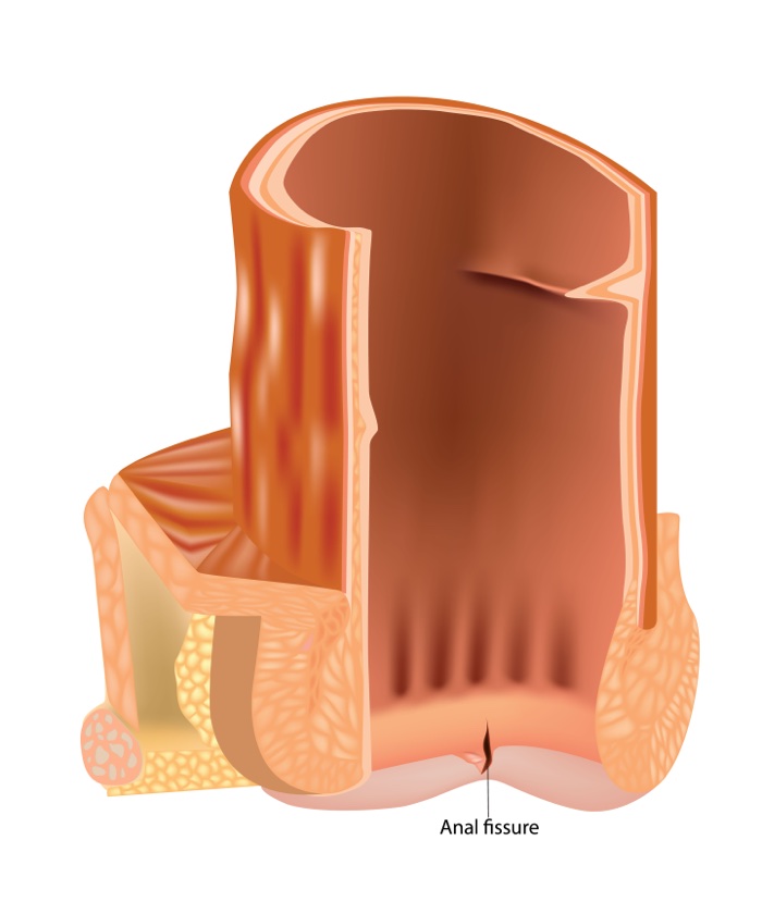 Diagram of the anal canal showing an anal fissure, a small tear in the lining
