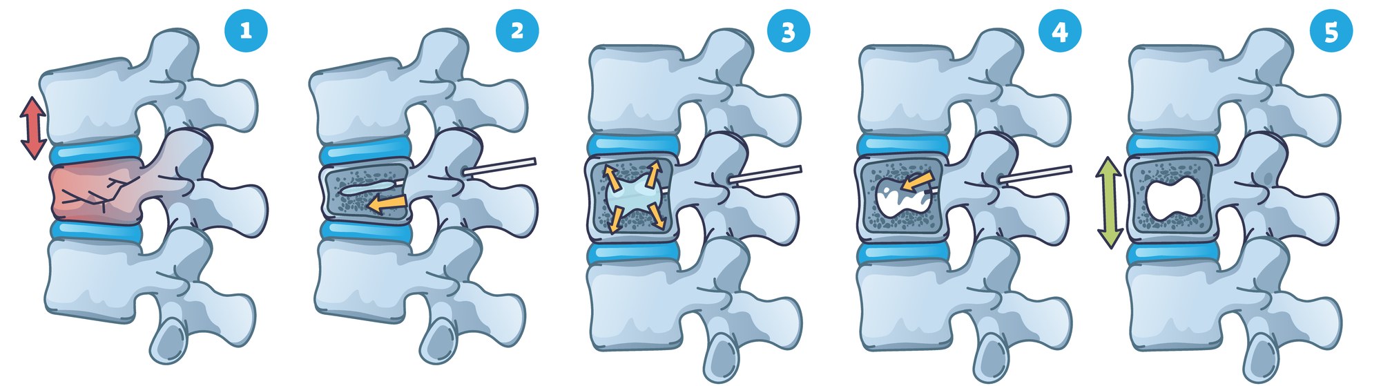 Five-panel illustration of balloon kyphoplasty: a compressed vertebra; a needle and balloon placed inside it; the balloon inflated to open a space; the balloon removed and cement placed; the cement hardened, holding the vertebra stable