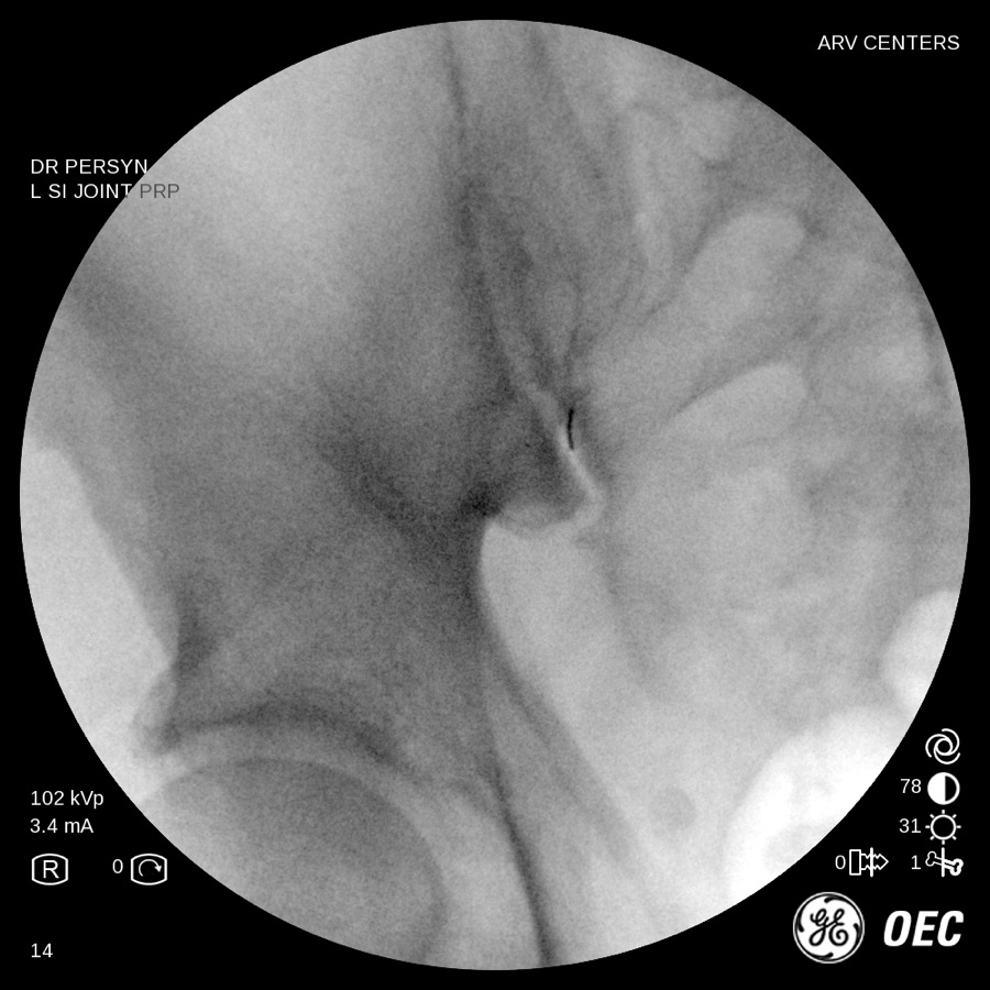 Fluoroscopy arthrogram of an SI joint injection at ARV Centers, with contrast dye outlining the joint space