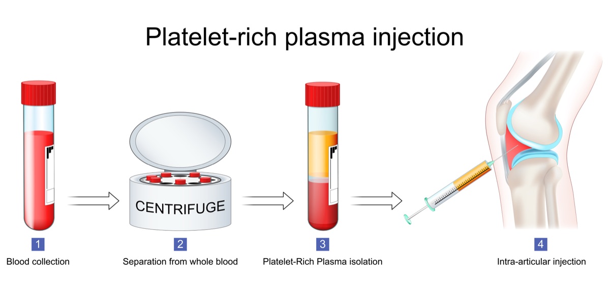 Four-step diagram of a PRP injection: blood collection, separation in a centrifuge, platelet-rich plasma isolation, and image-guided injection into the joint