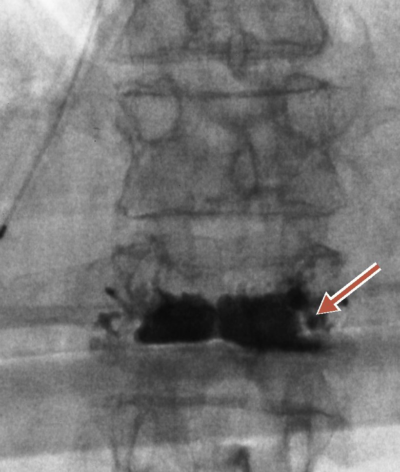 Front-view live X-ray during a kyphoplasty, with an arrow marking the cement — two dark shapes — inside the fractured vertebra