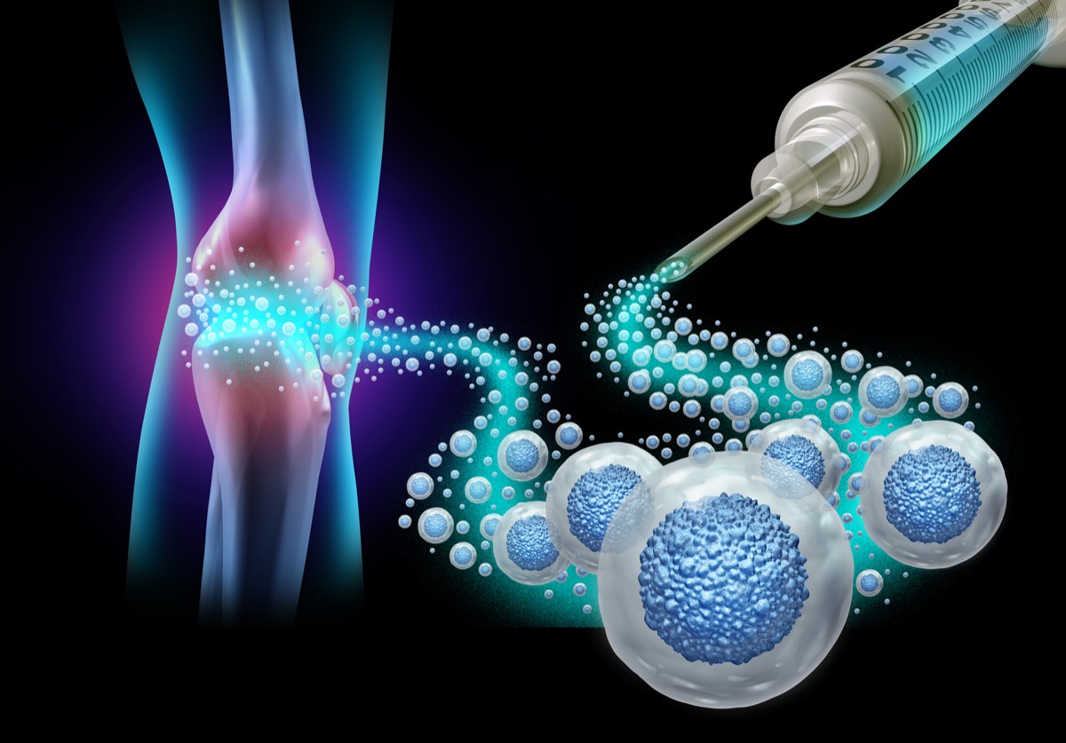 Illustration of a gel injection cushioning an arthritic knee joint