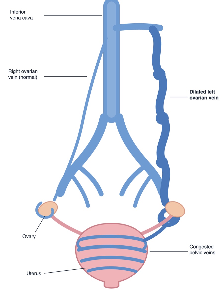 Illustration of the pelvic veins: a normal right ovarian vein beside a dilated, tortuous left ovarian vein draining into congested pelvic veins around the uterus
