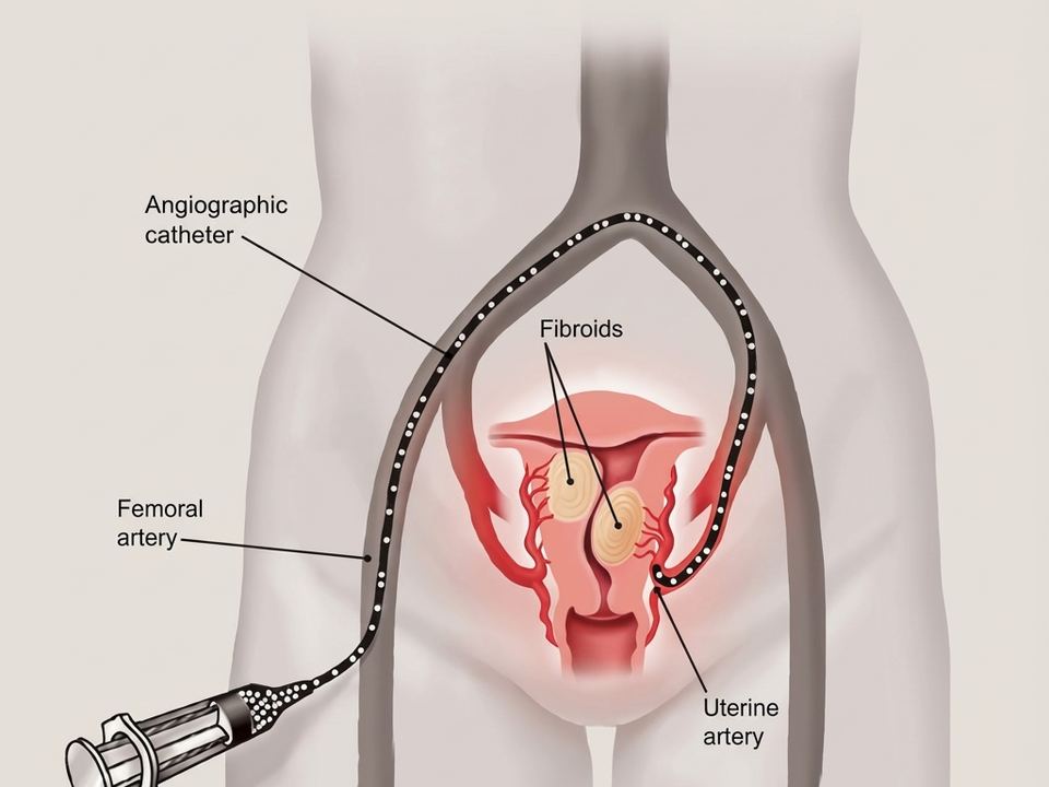 Illustration of the UFE procedure: a catheter delivering particles to the arteries feeding a fibroid
