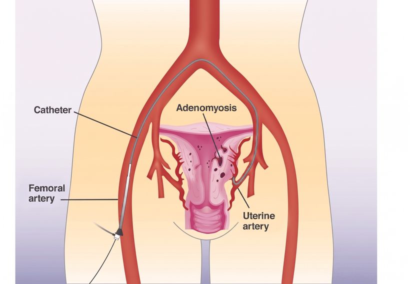 Illustration of uterine artery embolization: a catheter guided from the femoral artery to the uterine arteries