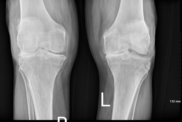 Knee X-ray showing bone-on-bone arthritis