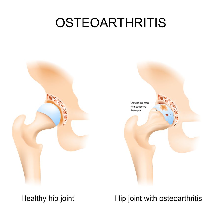 Medical illustration comparing a healthy hip joint with a hip joint with osteoarthritis: narrowed joint space, worn cartilage, and bone spurs