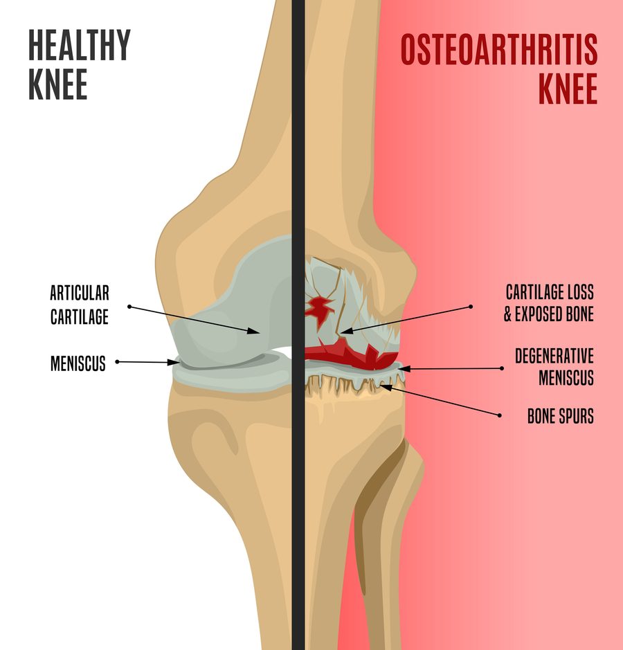 Medical illustration comparing a healthy knee, with smooth articular cartilage and an intact meniscus, to an osteoarthritic knee showing cartilage loss with exposed bone, a degenerative meniscus, and bone spurs