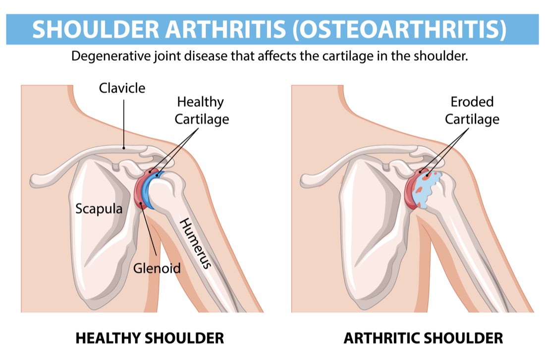 Medical illustration comparing a healthy shoulder joint with an arthritic shoulder joint with eroded cartilage