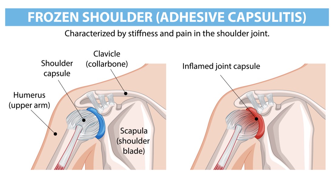 Medical illustration of frozen shoulder: a normal shoulder capsule next to an inflamed, thickened joint capsule