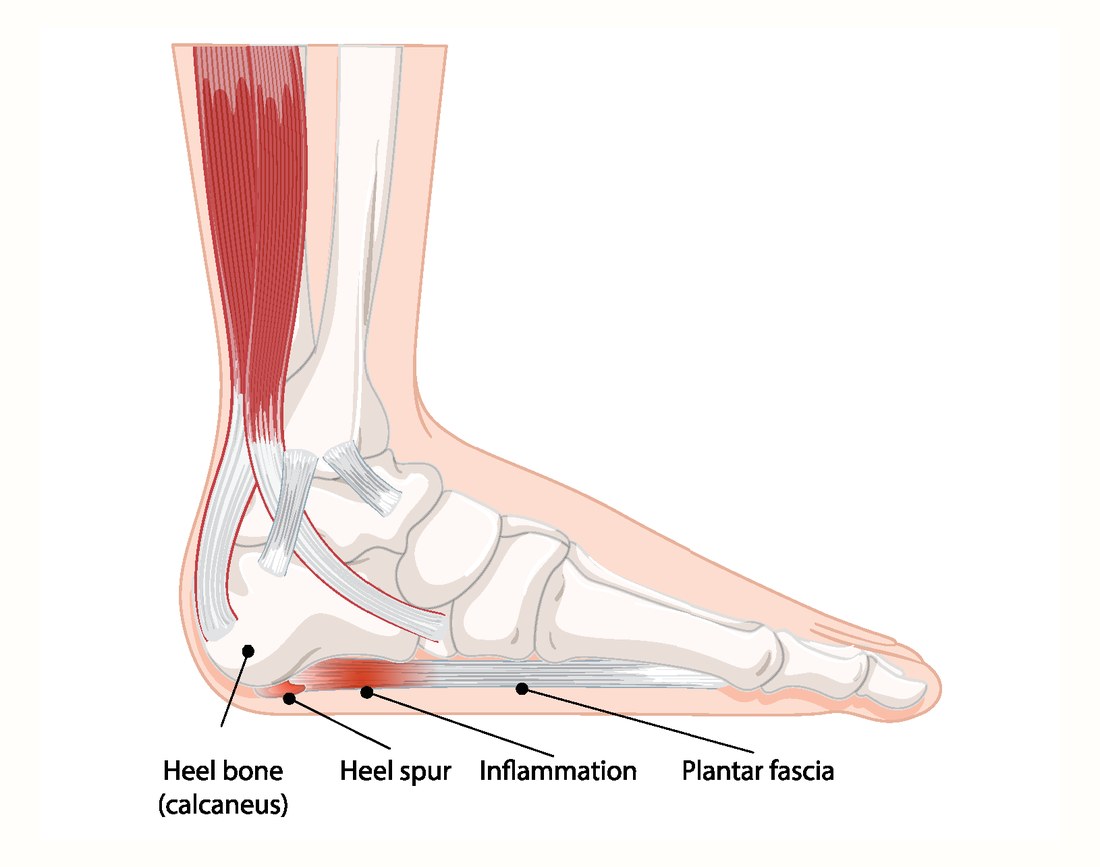 Medical illustration of the foot in cross-section: the plantar fascia running from the heel bone to the toes, with the inflamed attachment at the heel and a heel spur labeled