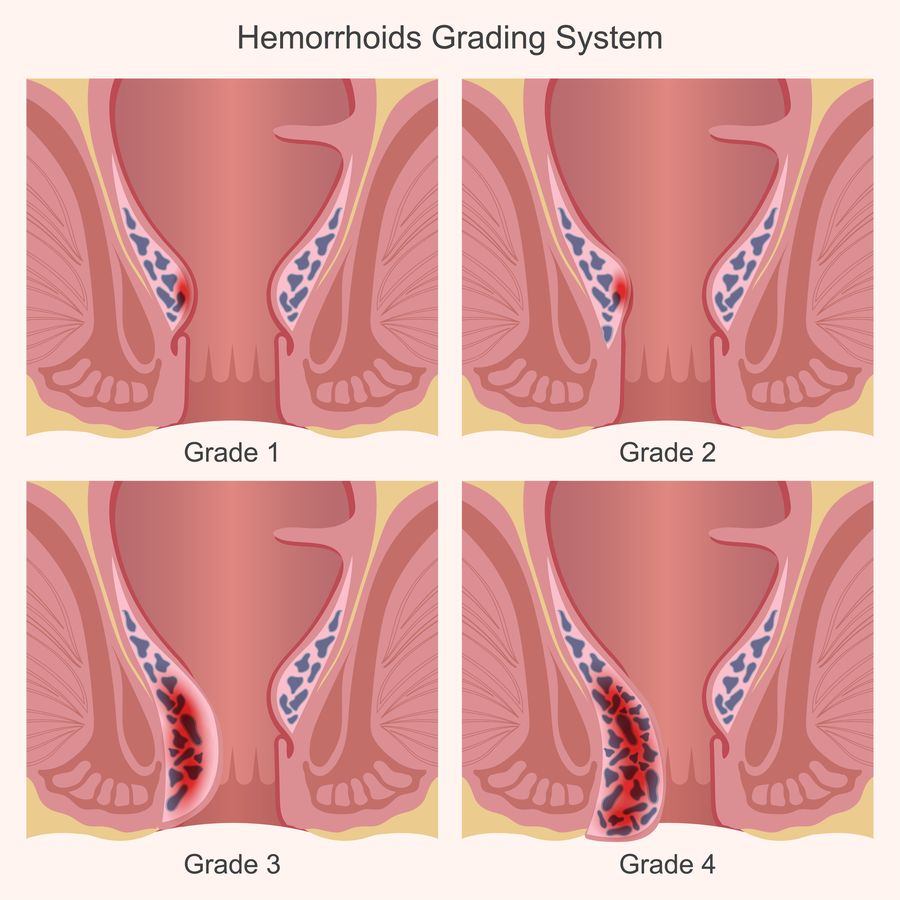 Medical illustration of the four grades of internal hemorrhoids, from grade 1 inside the anal canal to grade 4 chronically prolapsed