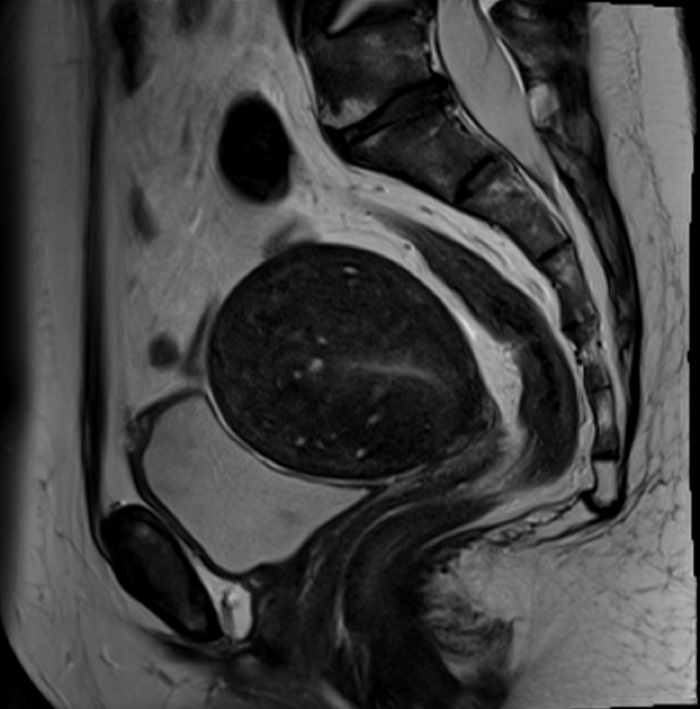 Sagittal T2-weighted MRI of the pelvis showing a bulky uterus with a thickened junctional zone, consistent with adenomyosis