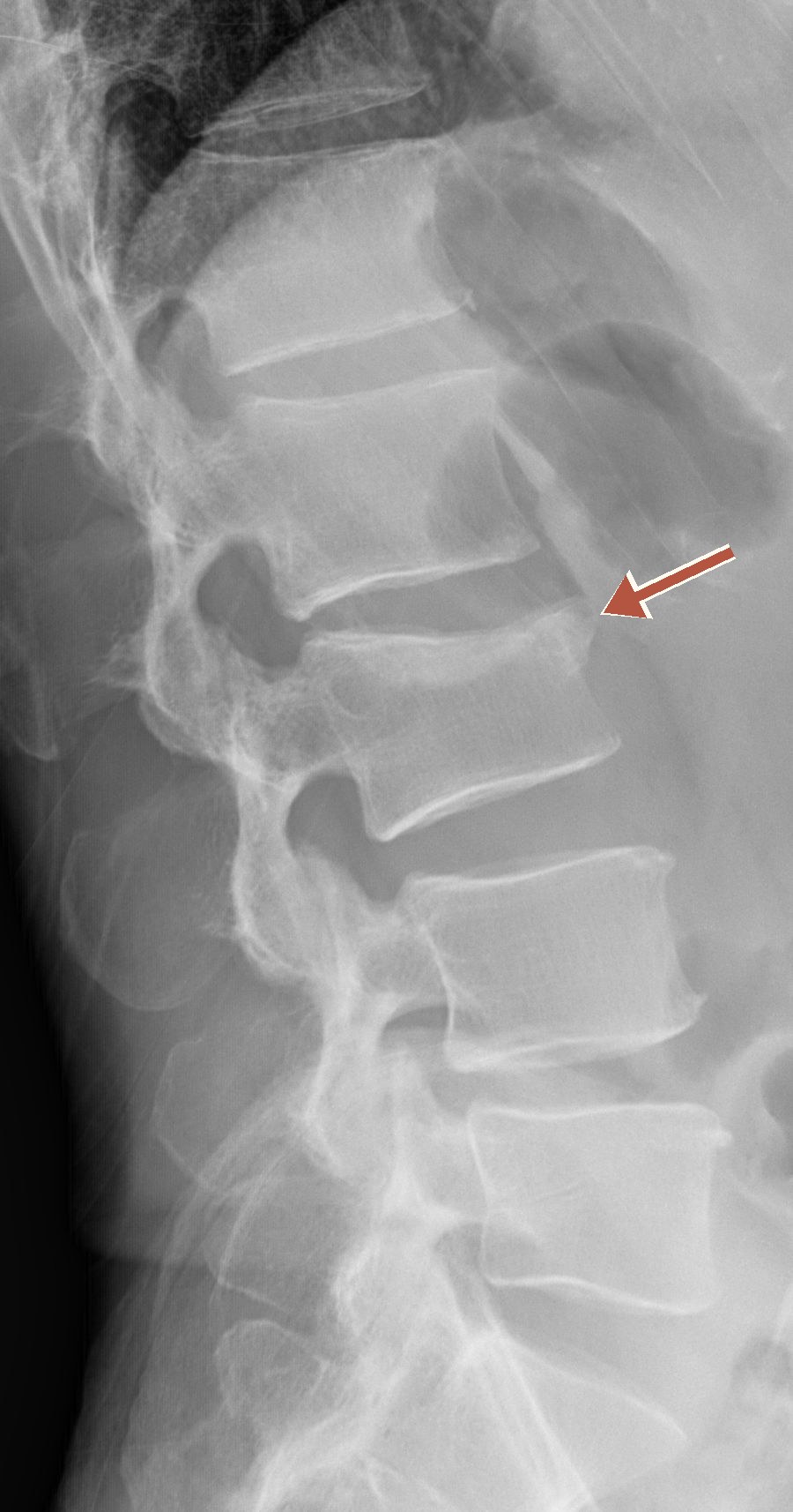 Side-view X-ray of the lower spine, standing, with an arrow marking the L3 vertebra, which has lost height at its front edge — a compression fracture