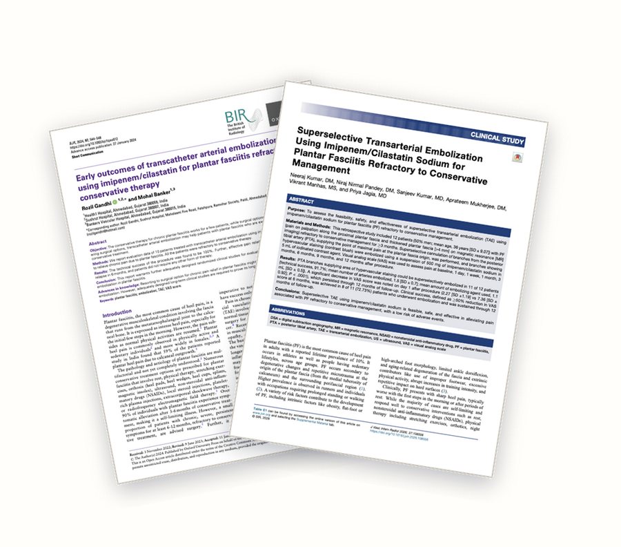Two published journal papers on transcatheter embolization for plantar fasciitis, fanned out