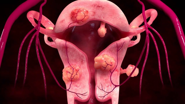 Video: 3-D animation showing how embolization blocks the arteries feeding uterine fibroids